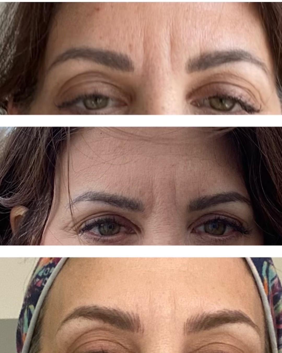 Cosmetic treatment comparison collage showing the forehead and brow area