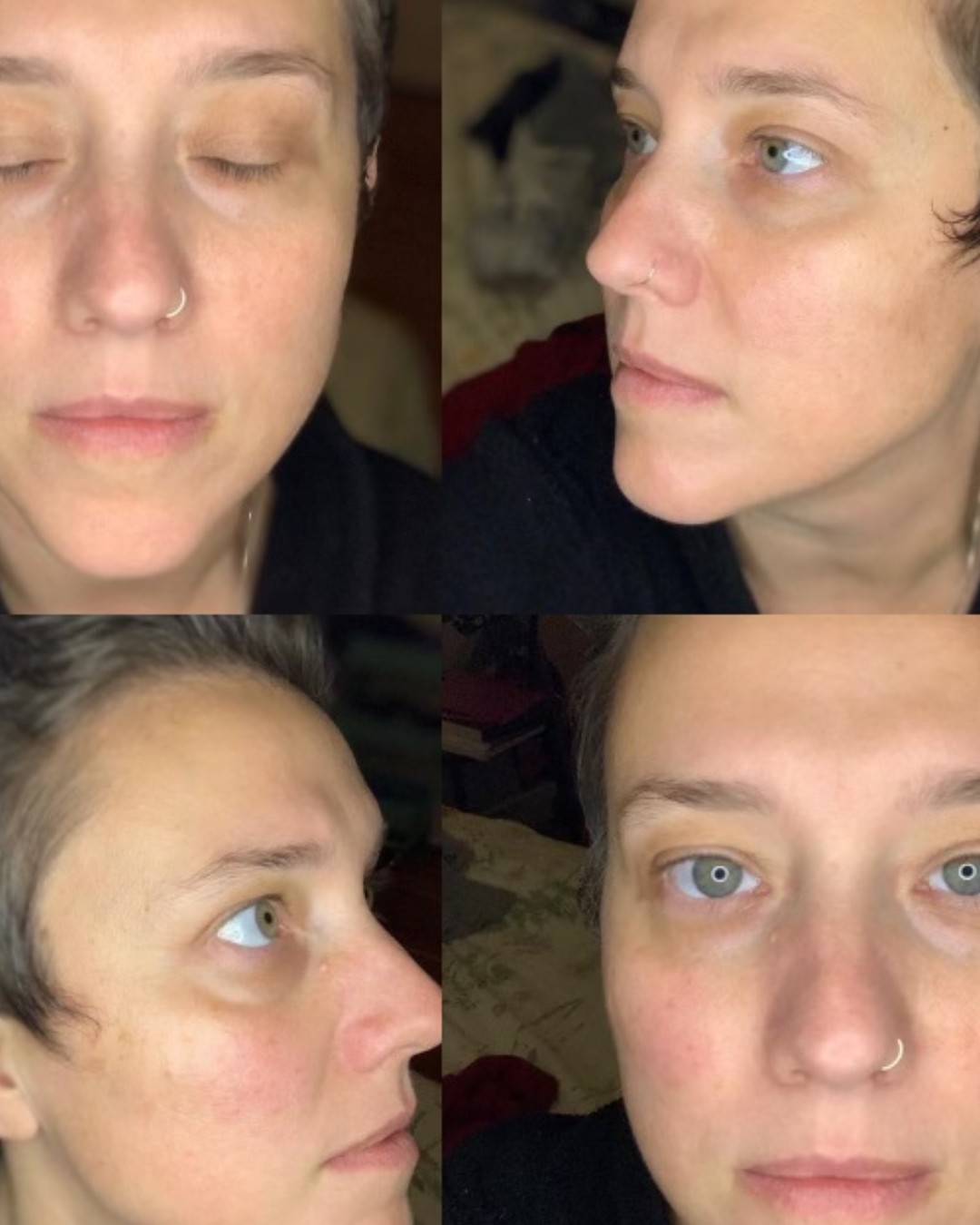 Cosmetic treatment comparison collage showing facial skin